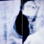 Rajasthan man with 75 pins inside his body in Mumbai for relief